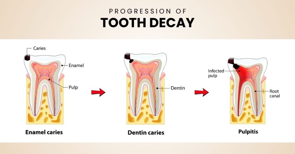 Progression of tooth decay