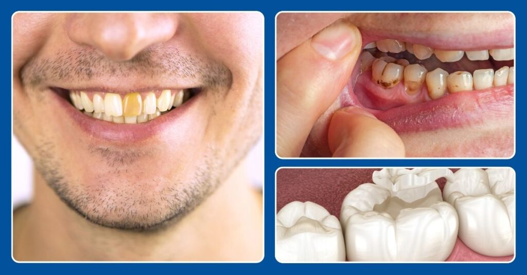 Common symptoms of dead tooth nerve in adults