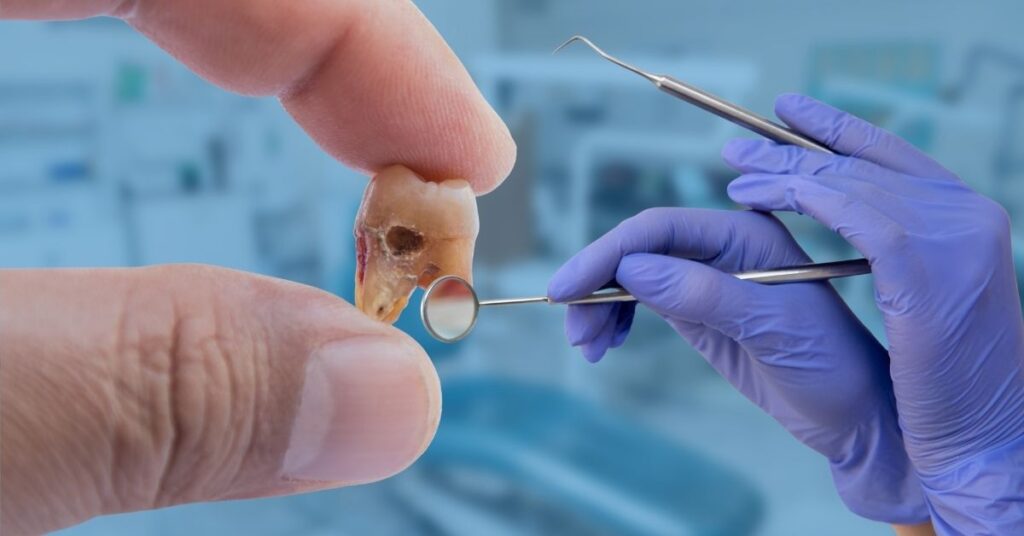 Dental treatment solutions for nerve death in teeth