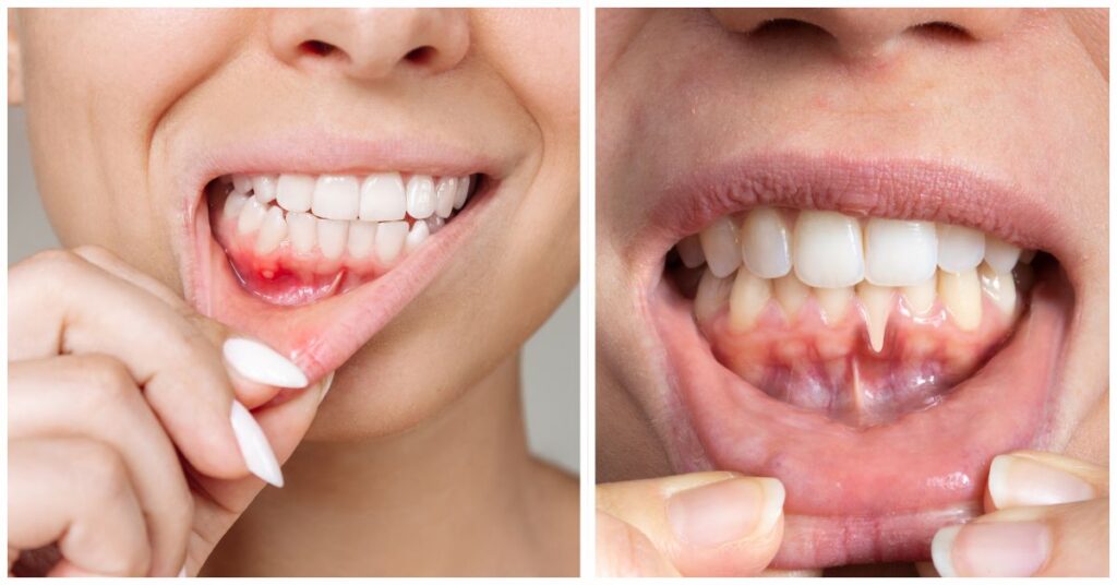 Gum infection close-up