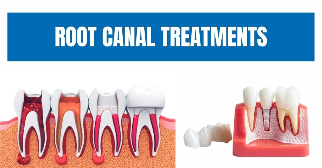 Root Canal
