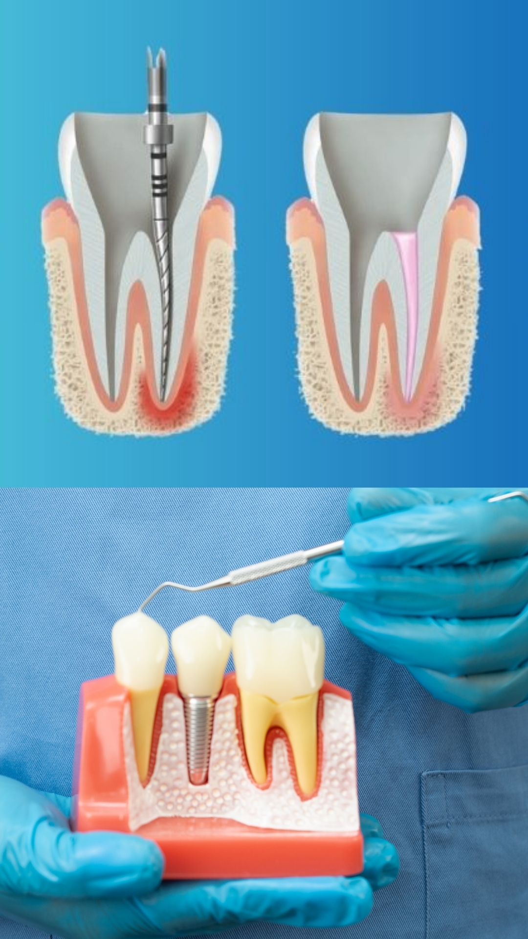Endodontics (Root Canal Treatment – RCT)
