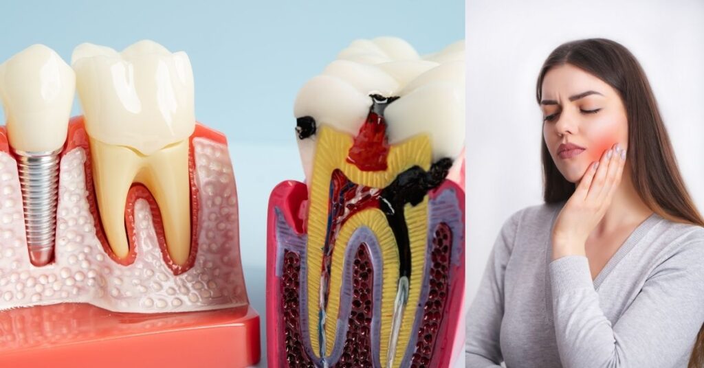 Awareness of Root Canals Signs You Might Need Treatment