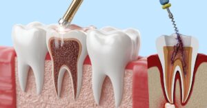 What to Expect During Your Root Canal Treatment