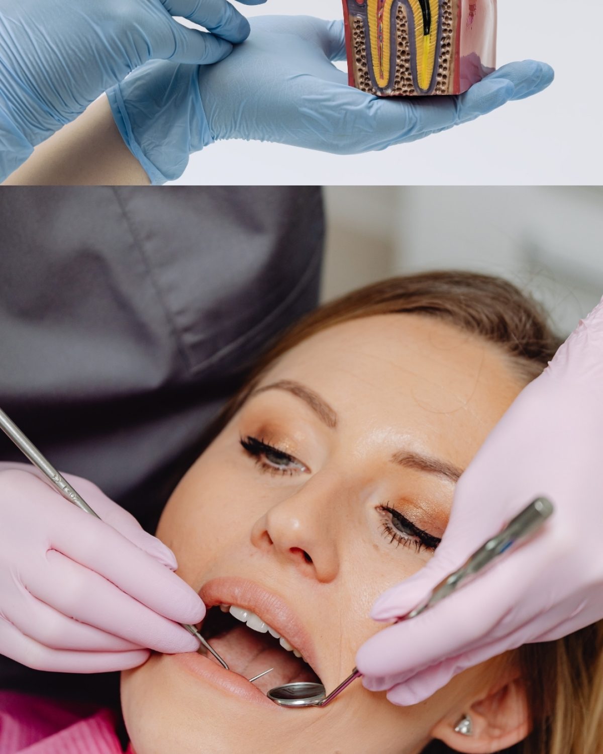 Endodontics (Root Canal Treatment – RCT)