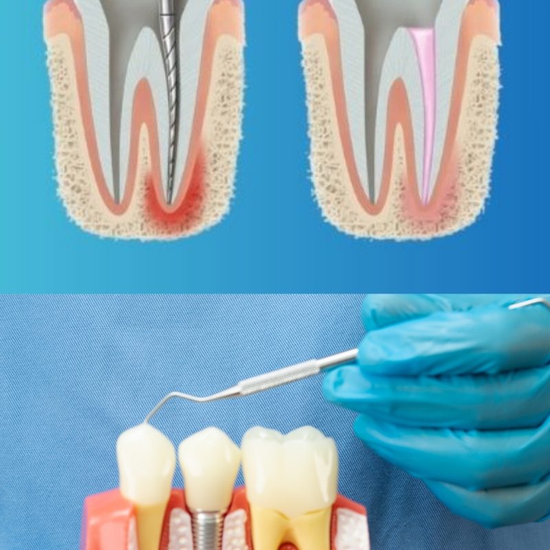 Endodontics (Root Canal Treatment – RCT)